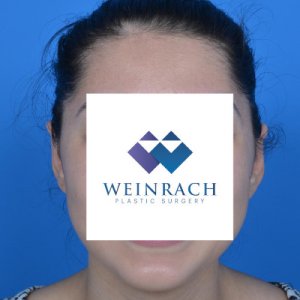 Otoplasty after front 0103