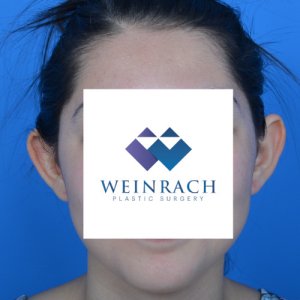Otoplasty before front 0103