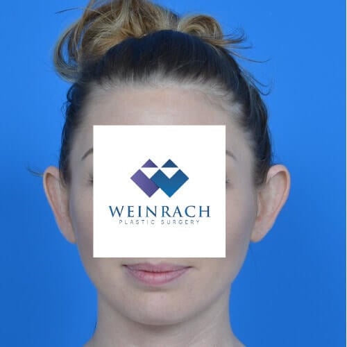 Otoplasty before front 1208 min
