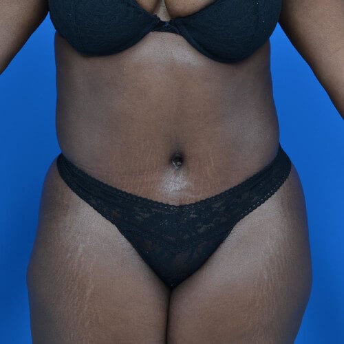 Tummy tuck after front 0701