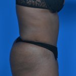 Tummy tuck after side 0701