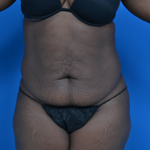 Tummy tuck before front 0701