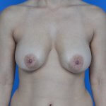 Breast lift with galaform 3d front before