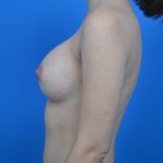 Breast augmentation after l side 300cc