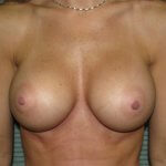 Breast-augmentation-after-front-saline-475cc