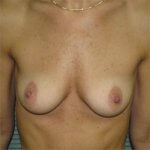 Breast-augmentation-before-front-saline-475cc