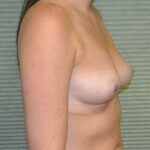 Breast augmentation before oblique 375cc