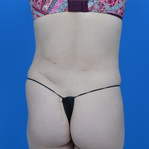 Liposuction back after