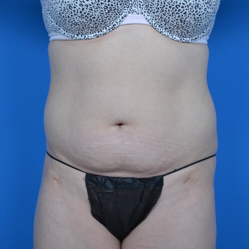 Liposuction front before