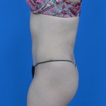 Mini tummy tuck and liposuction abdomen and flanks l side after