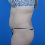 Mini tummy tuck and liposuction abdomen and flanks l side before