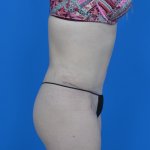 Mini tummy tuck and liposuction abdomen and flanks r side after