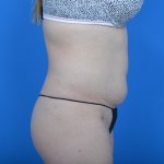 Mini tummy tuck and liposuction abdomen and flanks r side before