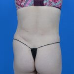 Mini tummy tuck and liposuction abdomen and flanks back after