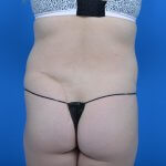Mini tummy tuck and liposuction abdomen and flanks back before