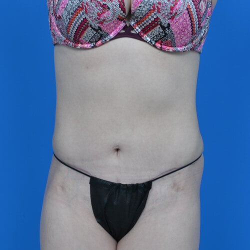 Mini tummy tuck and liposuction abdomen and flanks after