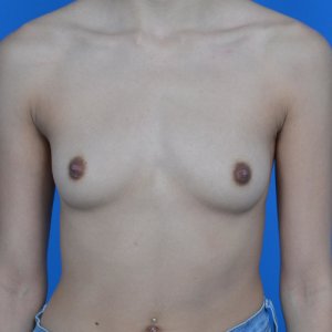 breast augmentation before front 350cc