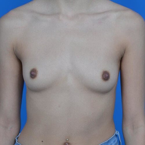 Breast augmentation before front 350cc