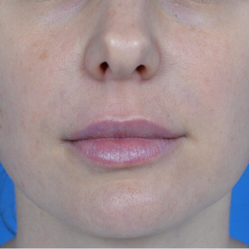 Lip augmentation juvederm after front