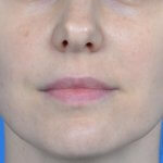 Lip augmentation juvederm ultra before front