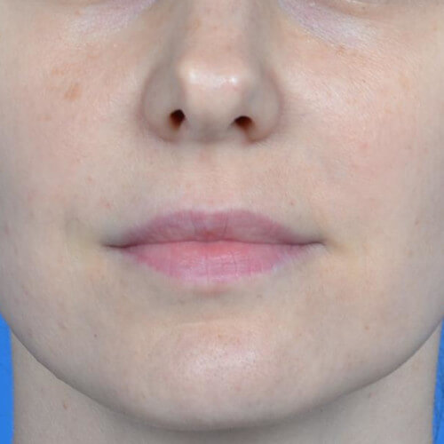 Lip augmentation juvederm ultra before front