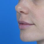 Lip augmentation juvederm after oblique