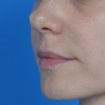 Lip augmentation juvederm before oblique