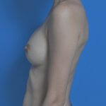 Breast augmentation after side 300cc
