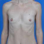 Breast augmentation before front 0806