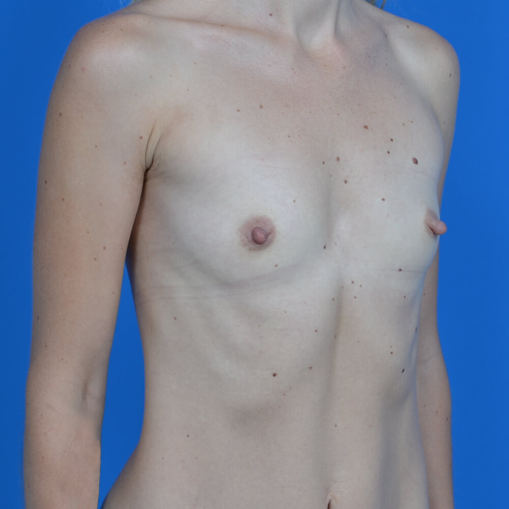Breast augmentation before oblique 0806