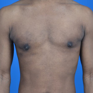 Gynecomastia excision after front