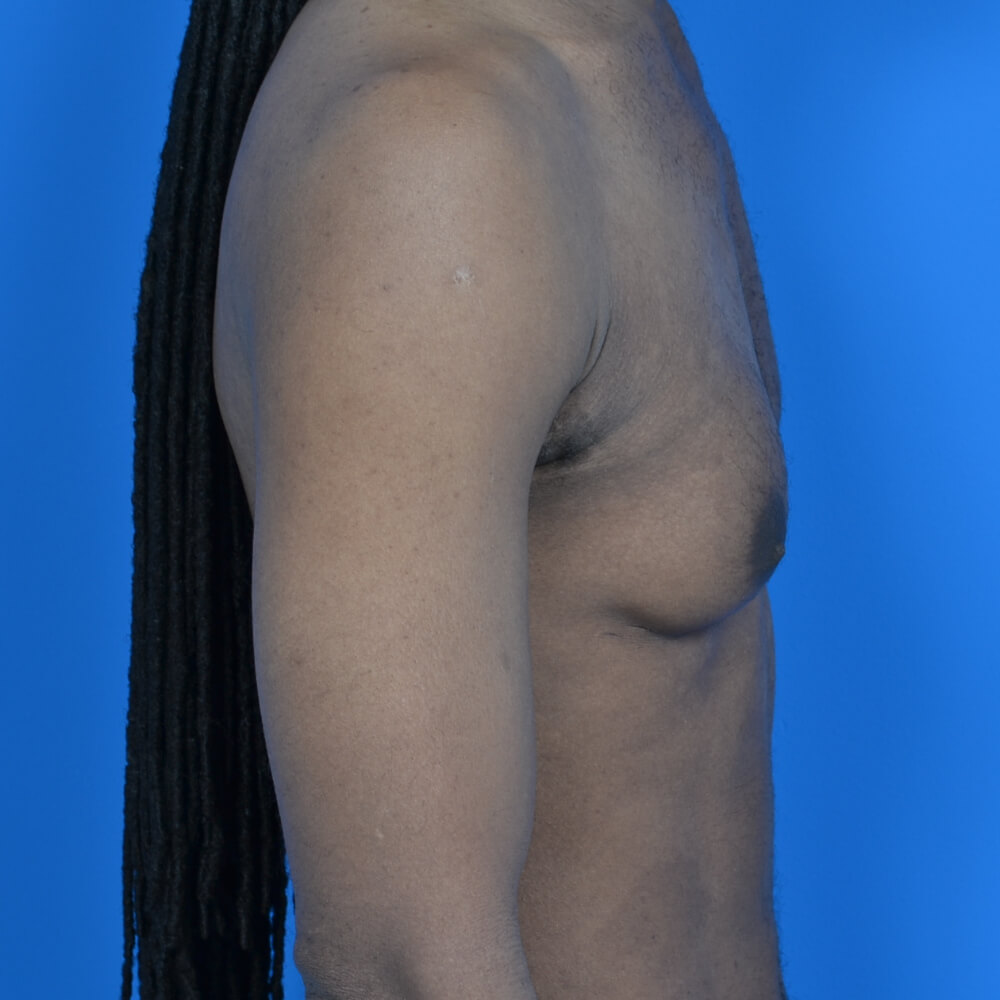 Gynecomastia excision before right side