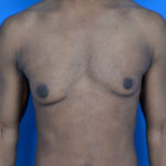 Gynecomastia excision before front
