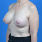 Breast augmentation with lift after left oblique