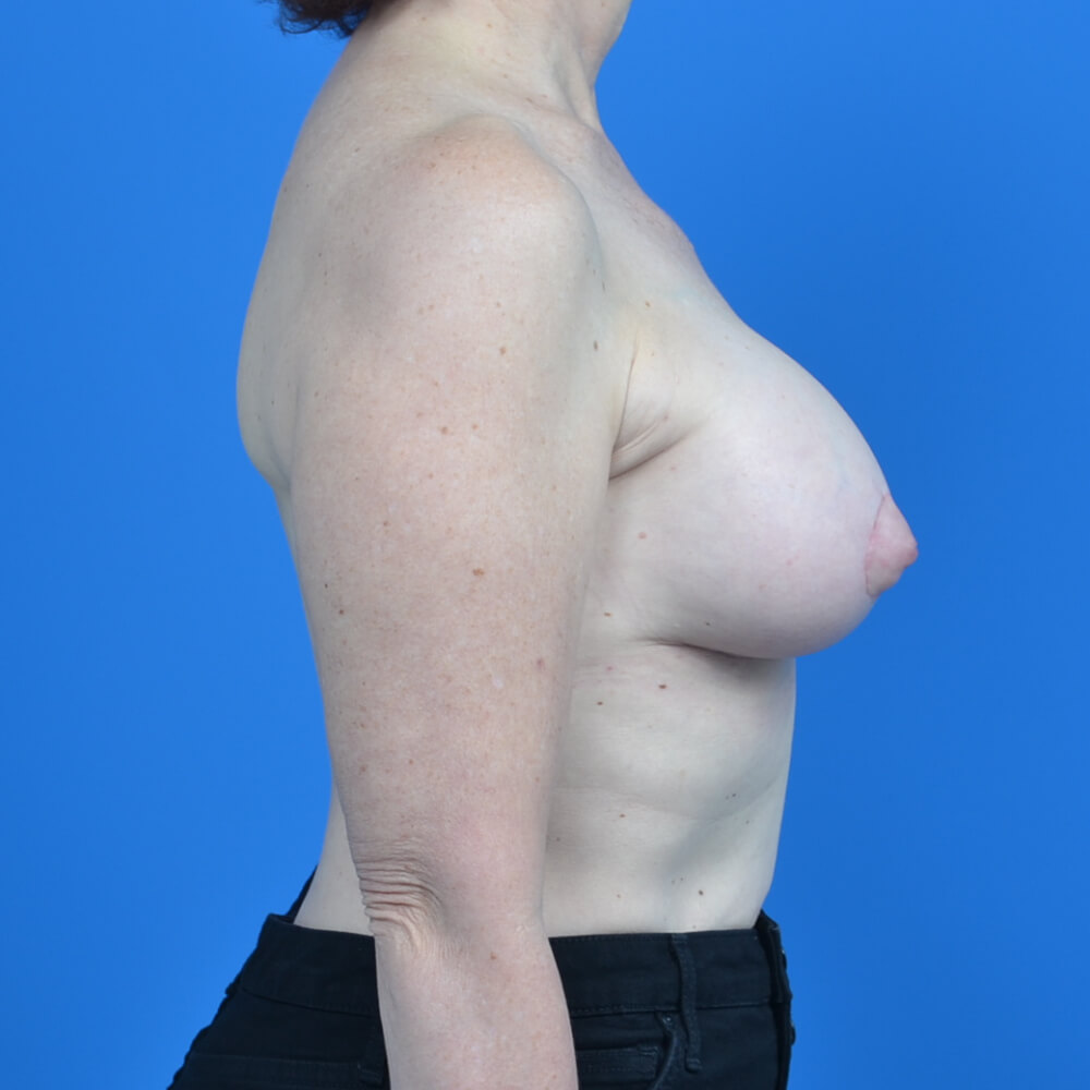 Breast augmentation with lift after right side