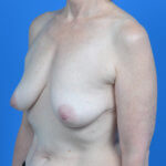 Breast augmentation with lift before left oblique
