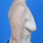 Breast augmentation with lift before right side