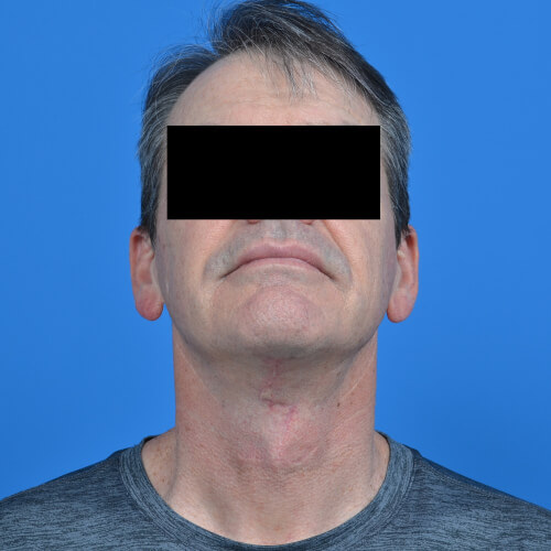 Male neck lift after front extended 1002