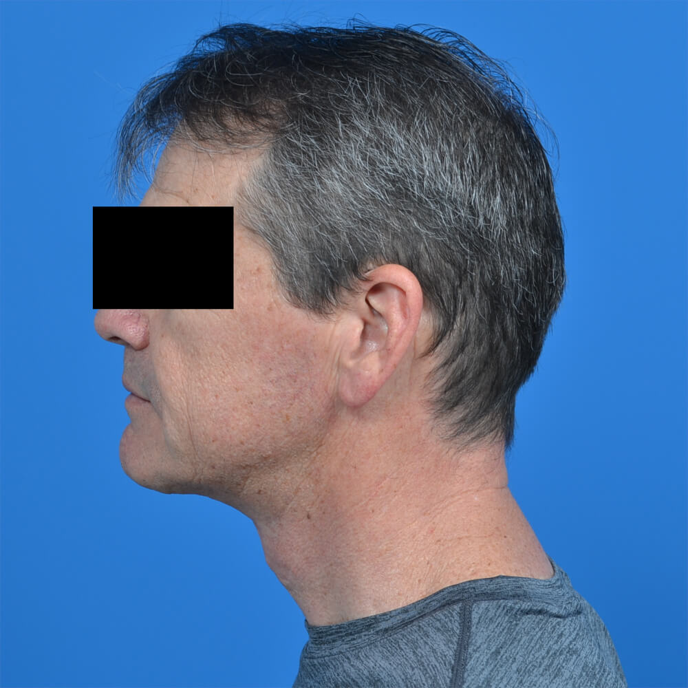 Male neck lift after lside 1002
