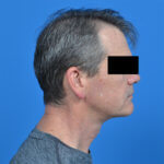 Male neck lift after r side 1002