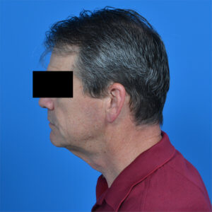 Male neck lift before lside 1002