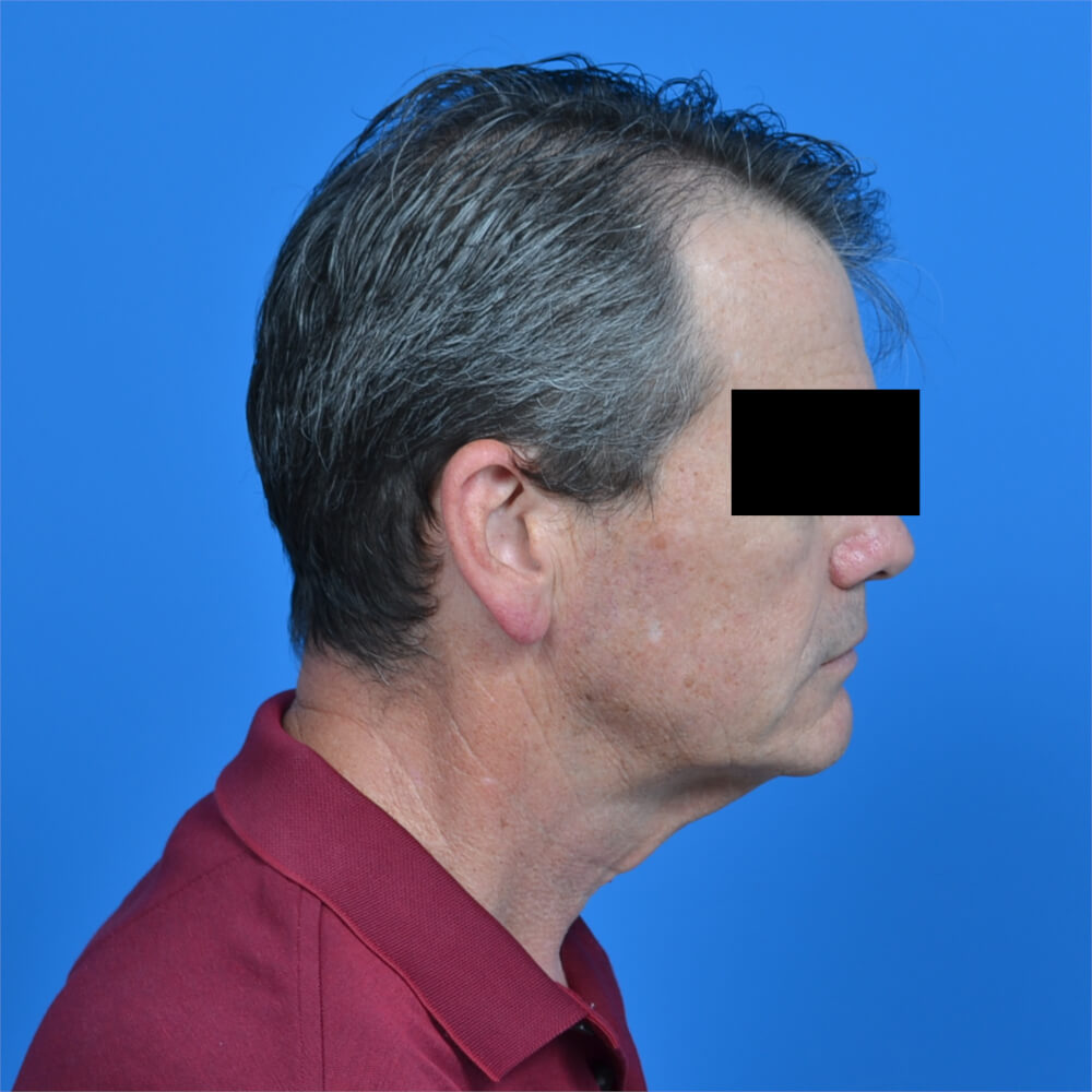 Male neck lift before r side 1002