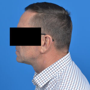 Tzplasty male neck lift after left side