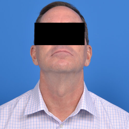 Tzplasty male neck lift before extended