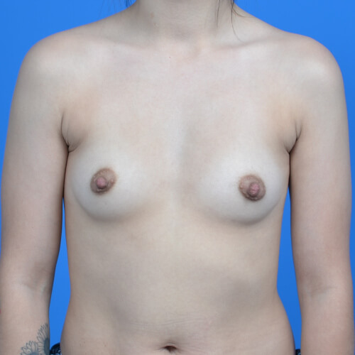 Breast augmentation before front 325cc natrelle ssf