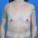 Allergan natrelle breast implants 345cc srf (full profile, responsive) before, front