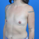Allergan natrelle breast implants 345cc srf (full profile, responsive) - before, oblique