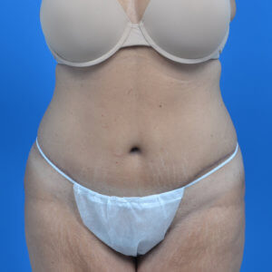 Tummy tuck after front 0719