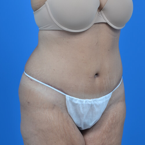 Tummy tuck after oblique 0719