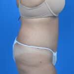 Tummy tuck after side 0719